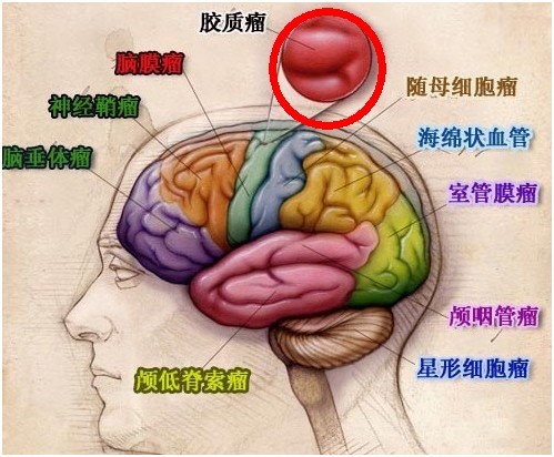 脑瘤分布示意图(脑胶质瘤的生长部位)